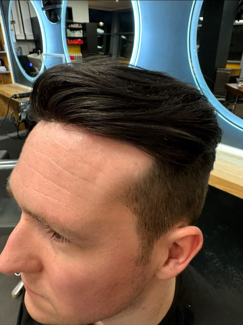 After: the same client wearing a colour-matched hair system, front view